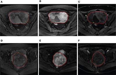 Nomograms of Combining MRI Multisequences Radiomics and Clinical Factors for Differentiating High-Grade From Low-Grade Serous Ovarian Carcinoma